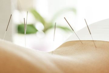 Acupuncture Point Injection Therapy